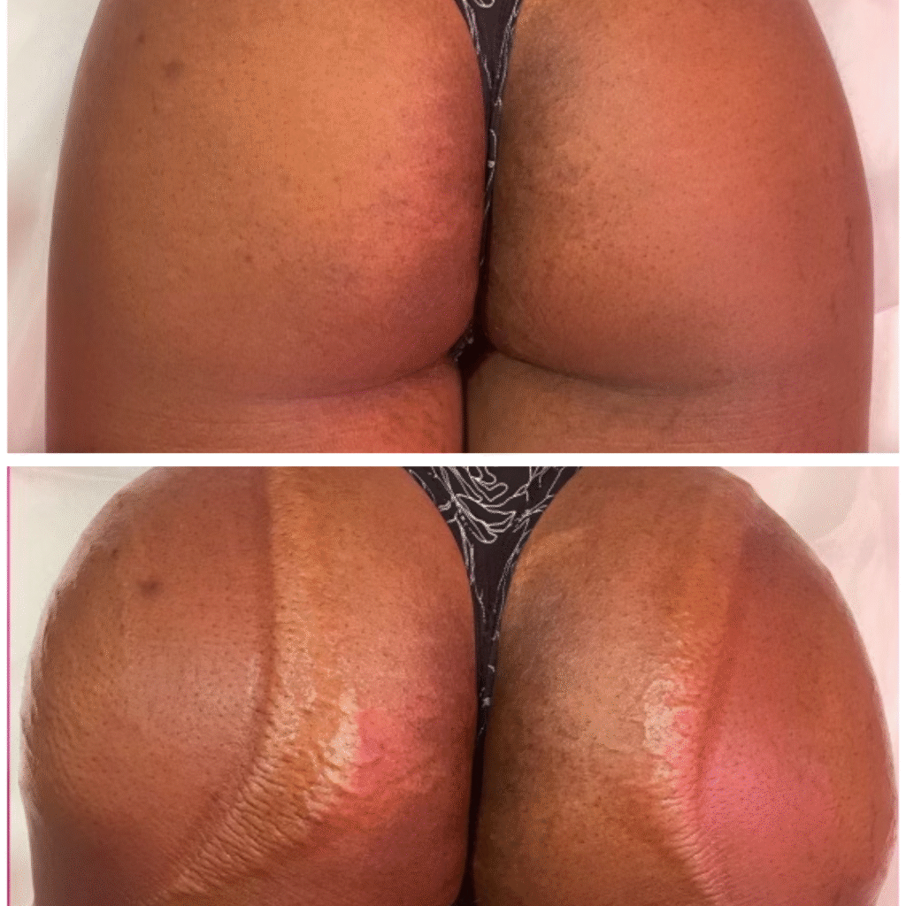 buttock enhancement