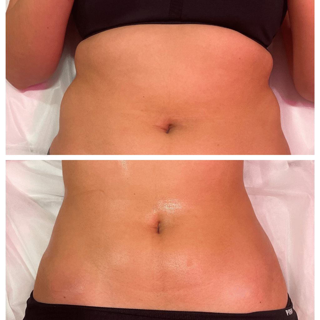 laser lipo services