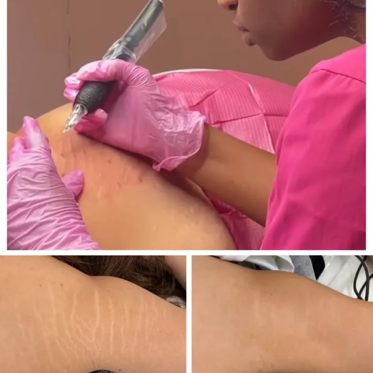stretch mark removal