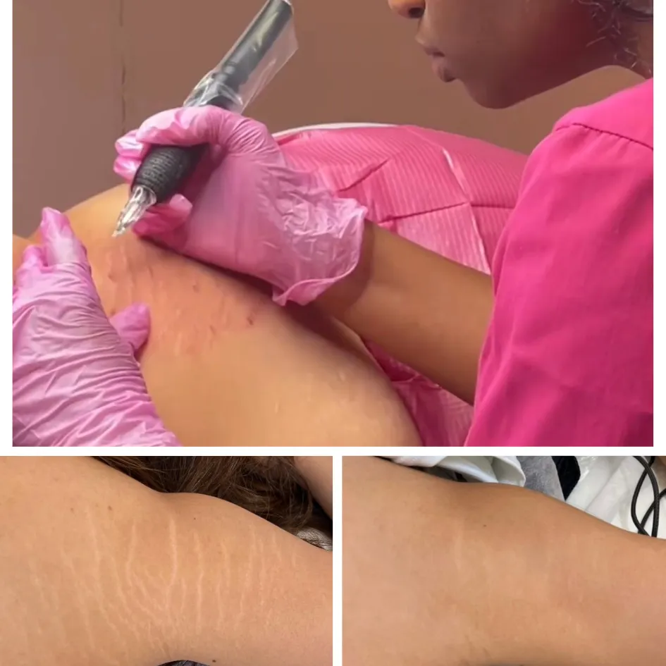 stretch mark removal