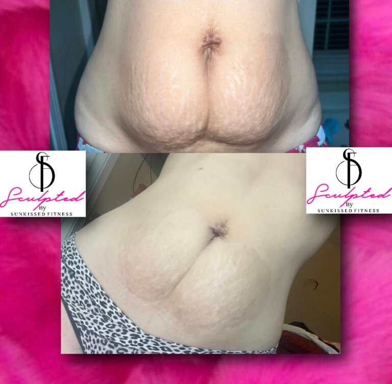 stretch mark removal from belly