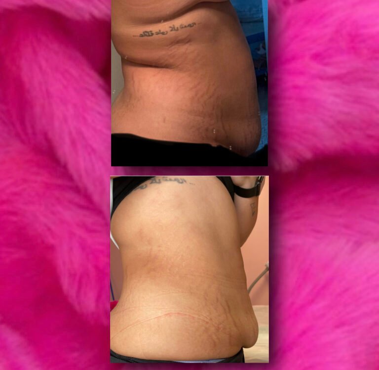 stretch mark removal from lower belly