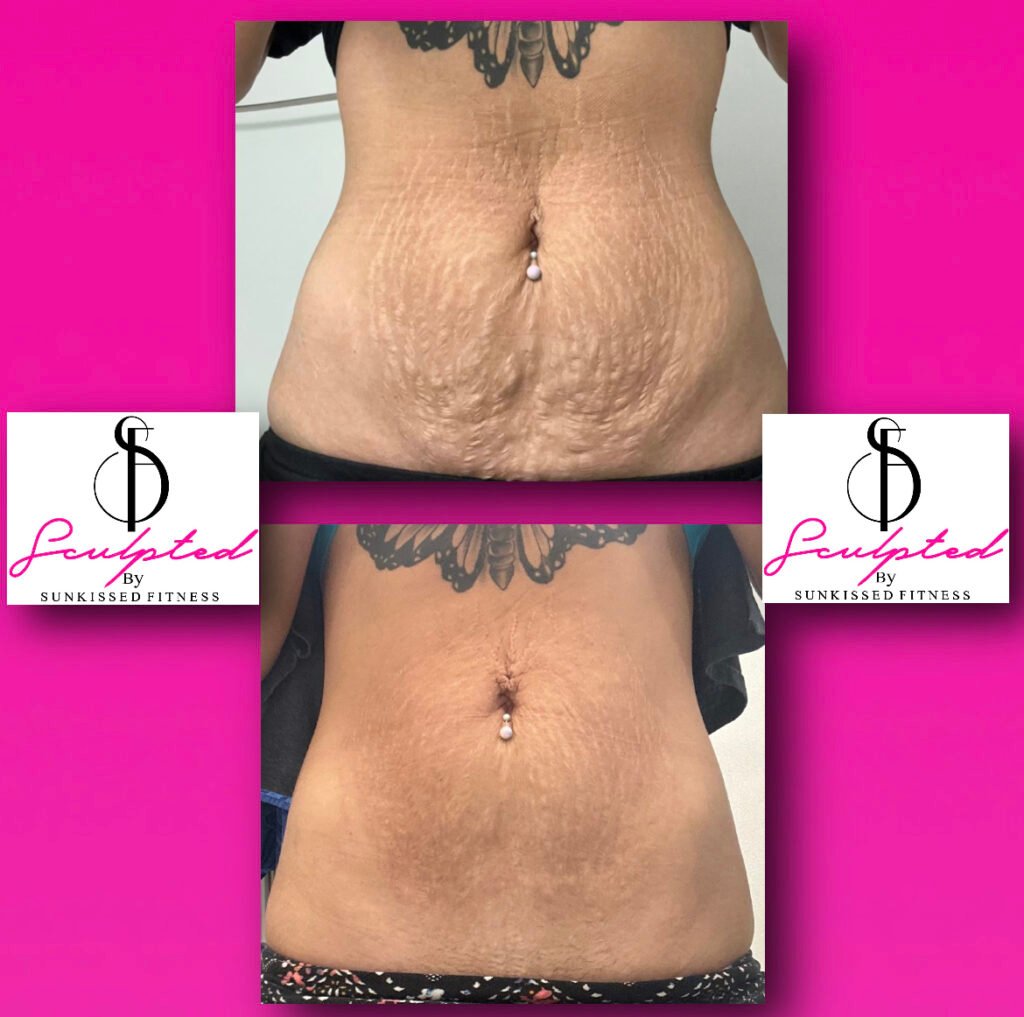 stretch mark removal from whole body