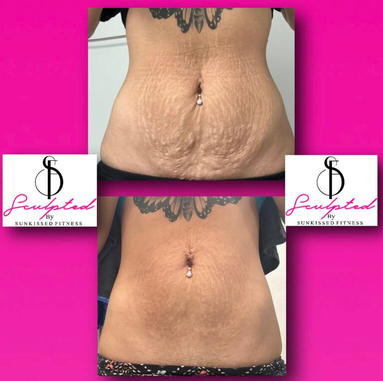 stretch mark removal from whole body