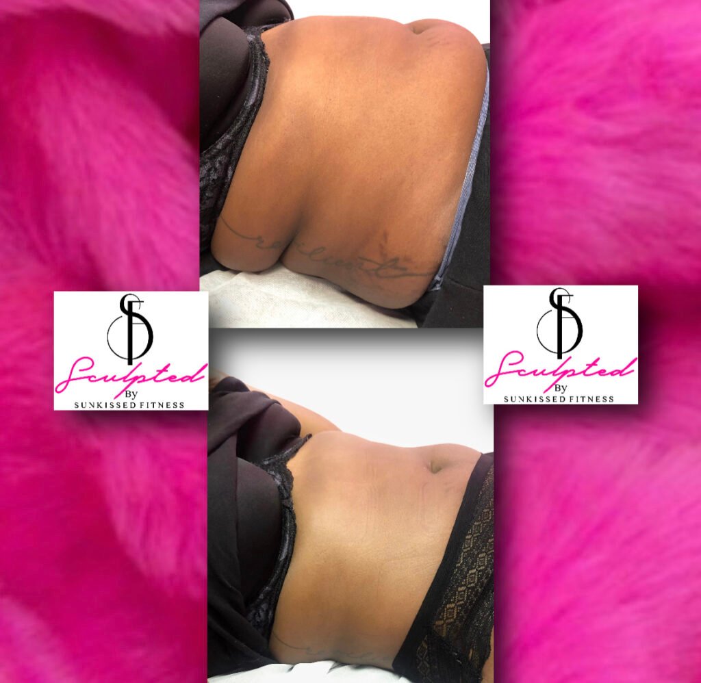 Fat removal without surgery (2)