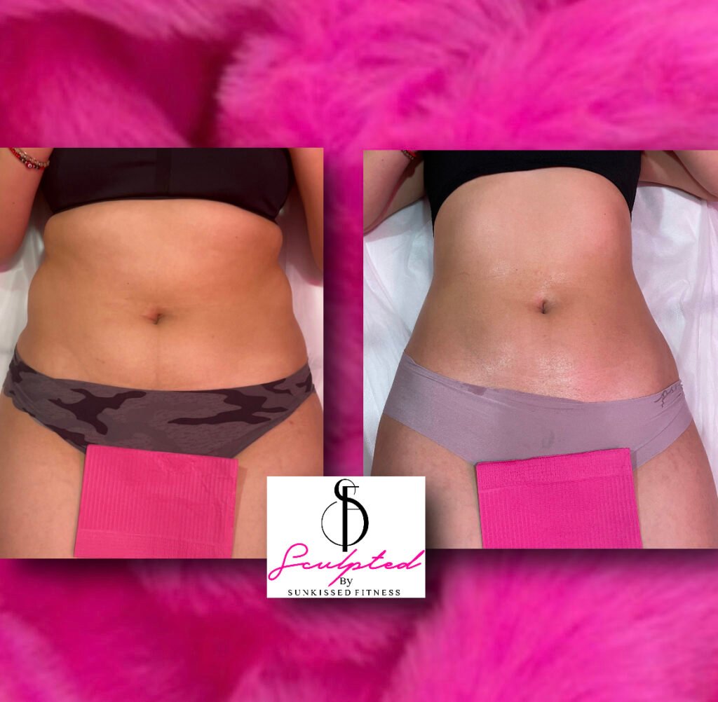 Laser lipo recovery time