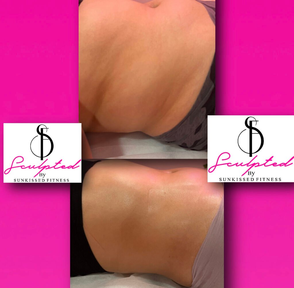 Smartlipo procedure