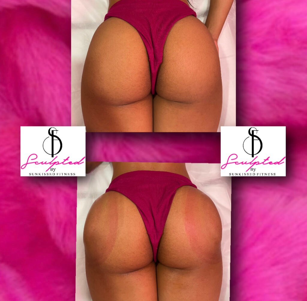 Vacuum therapy for bigger buttocks