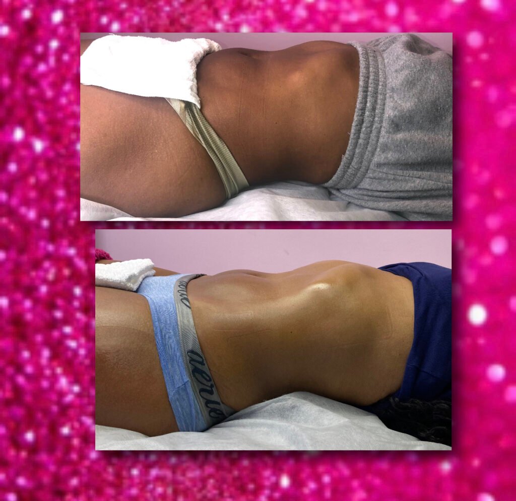 belly fat removal