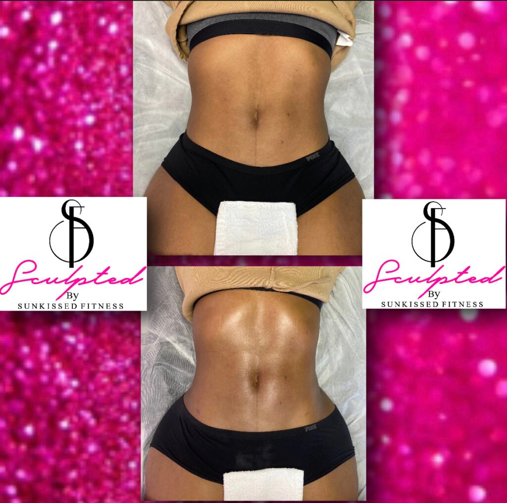 fat removal from stomatch