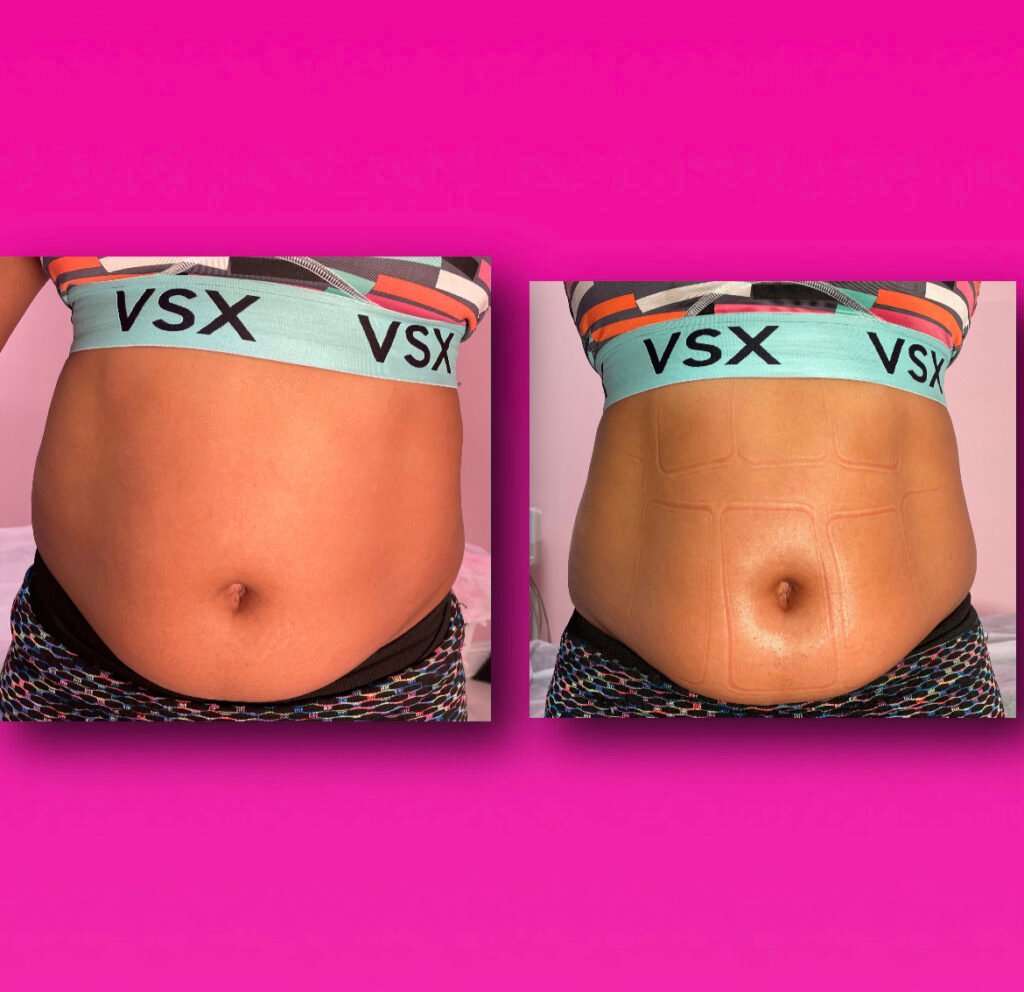 fat removal