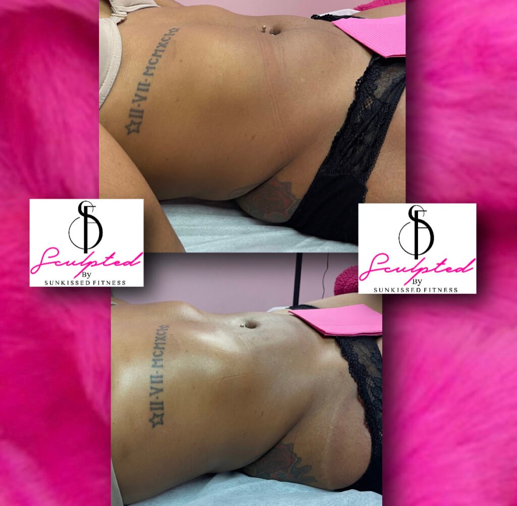 laer lipo