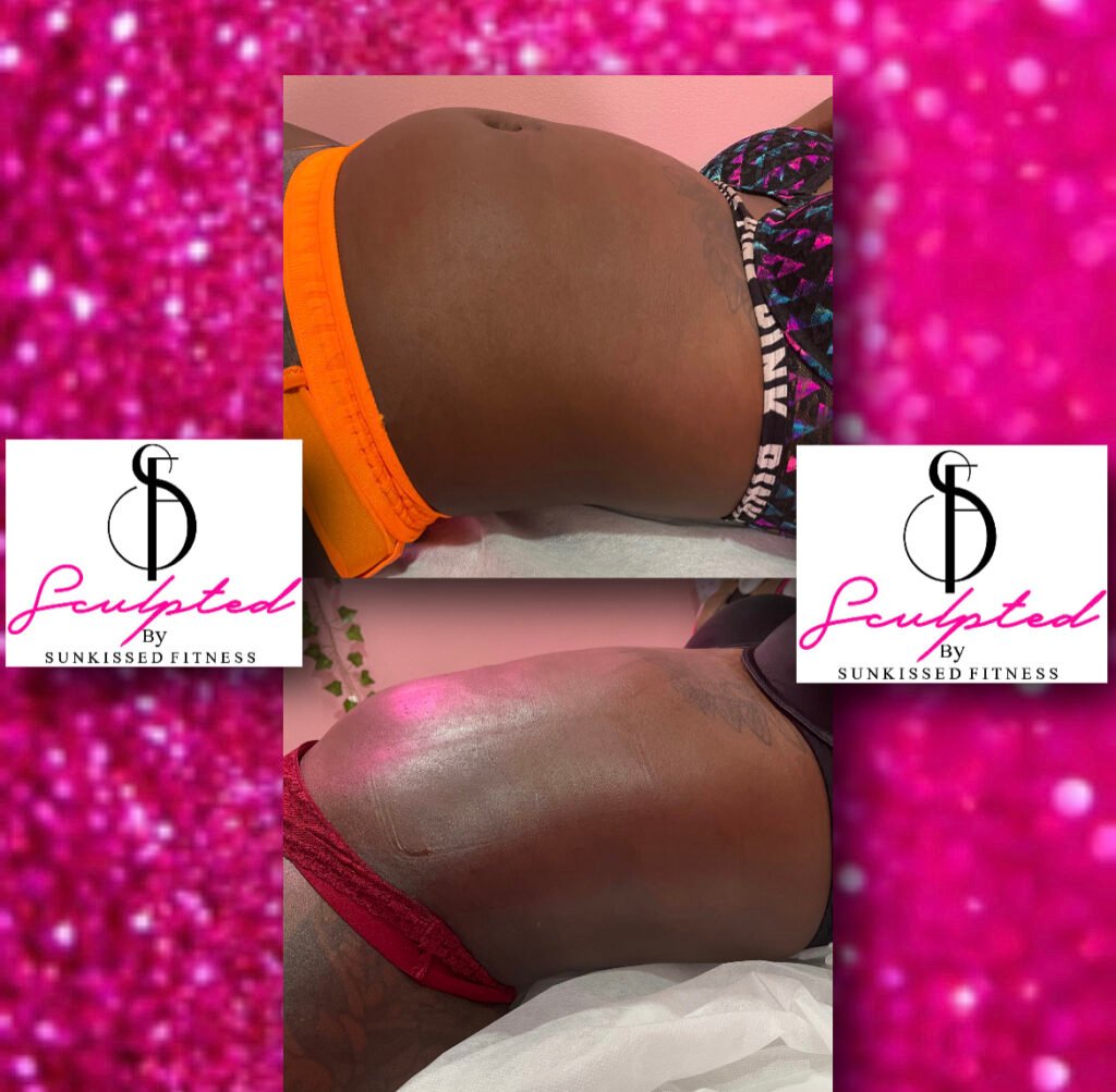 laser lip suction