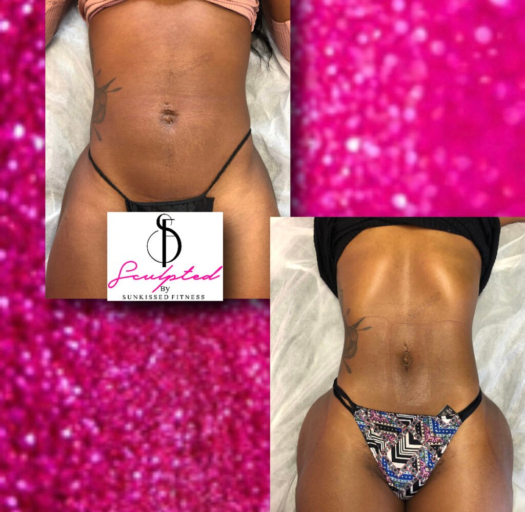 lipo suction
